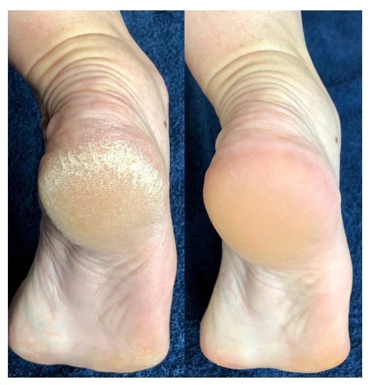 Moovital™ Rimuovi Calli Elettrico