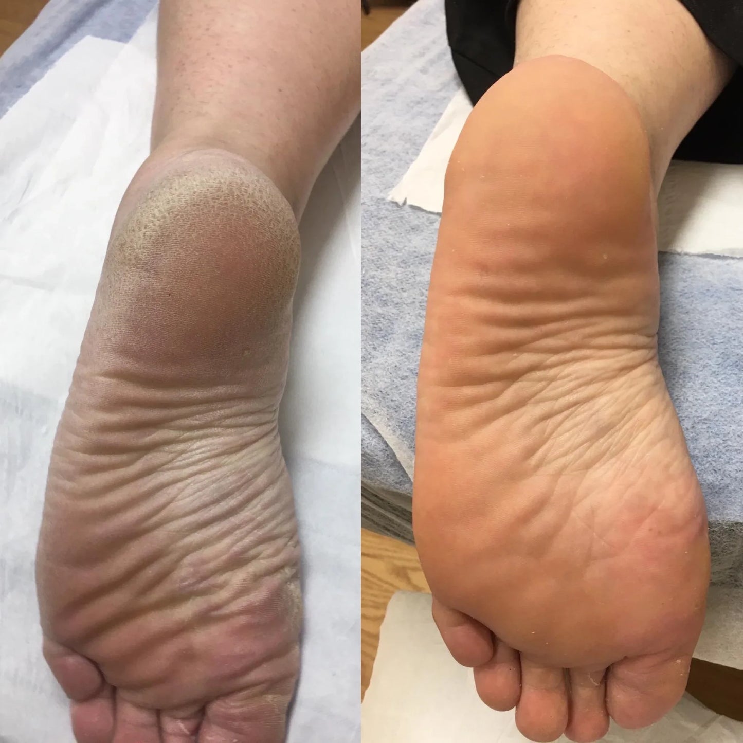 Moovital™ Rimuovi Calli Elettrico