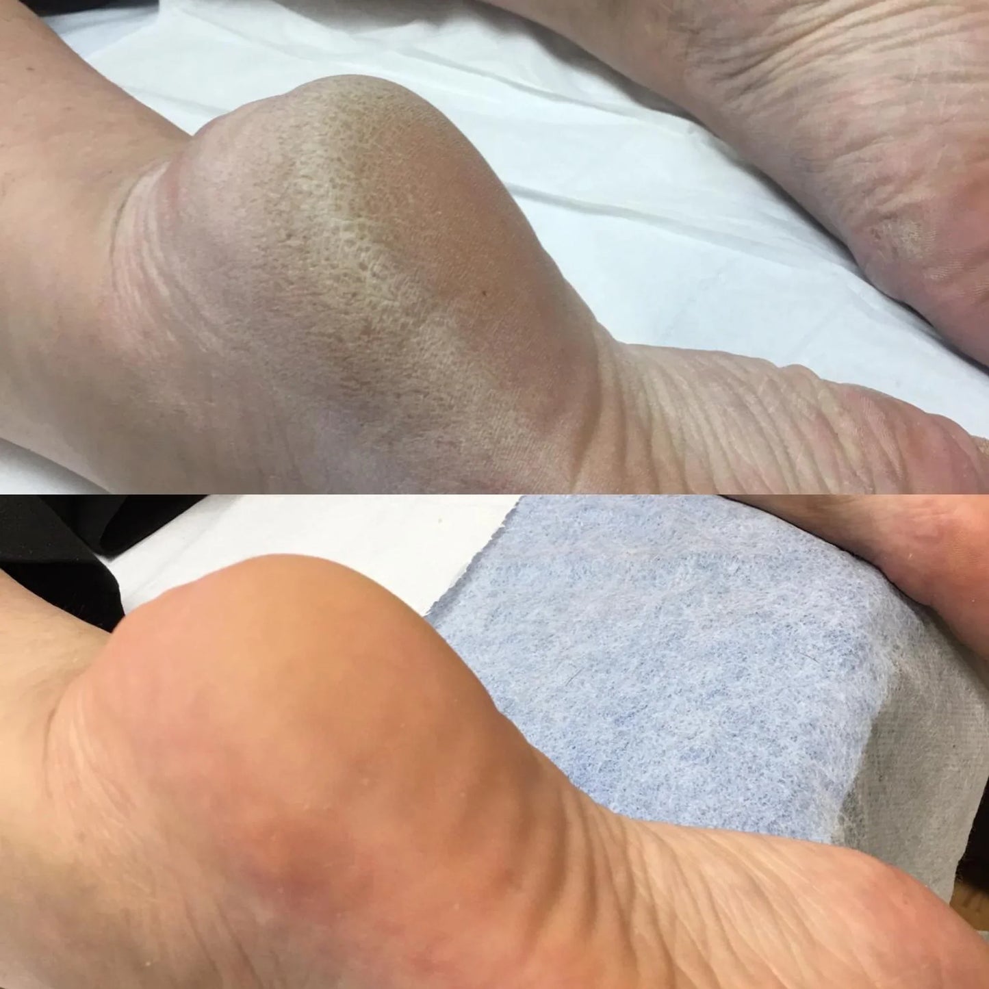 Moovital™ Rimuovi Calli Elettrico